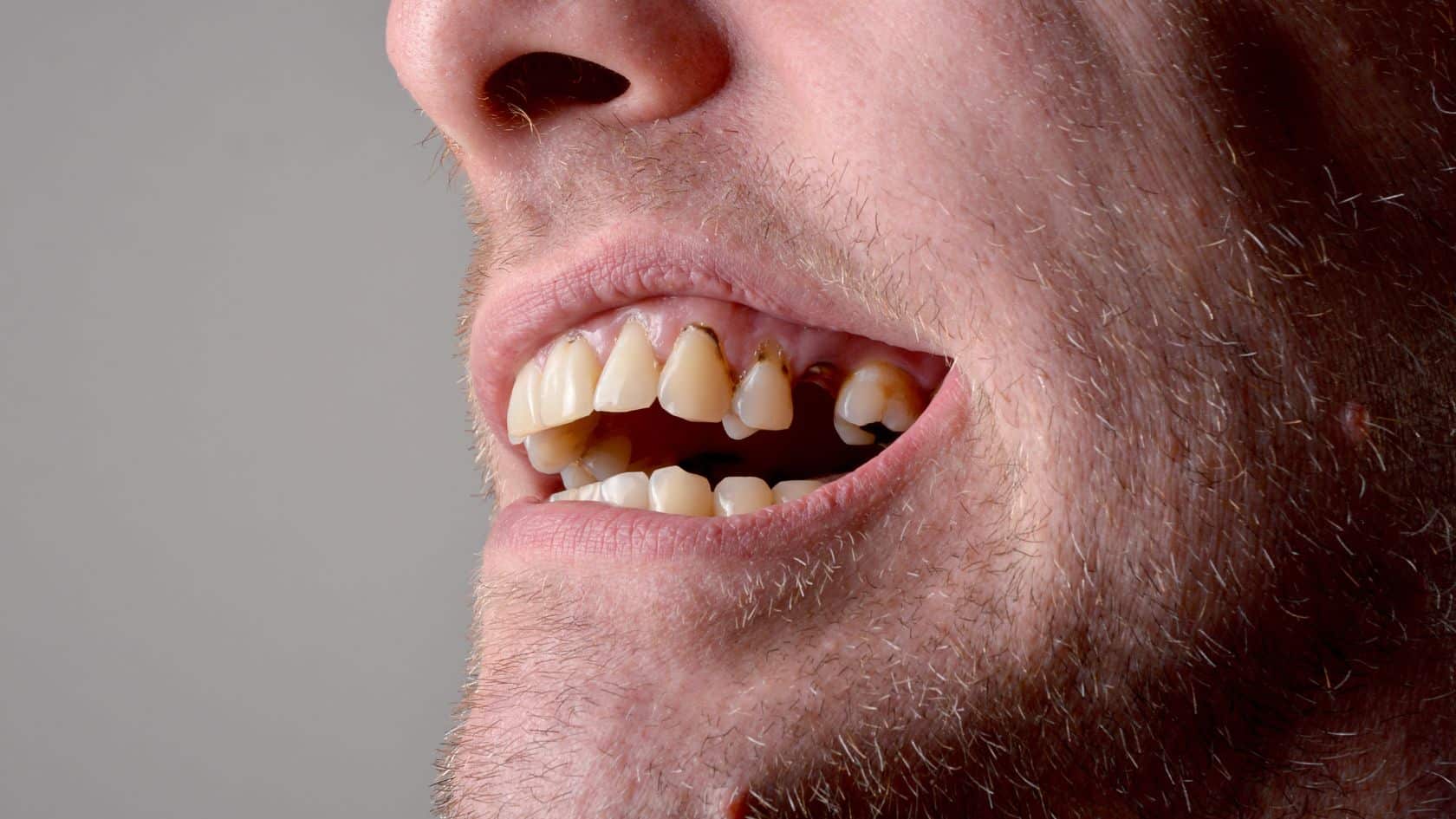 The 5 Stages of Tooth Decay: How to Protect Your Smile at Every Stage The 5 Stages of Tooth Decay: How to Protect Your Smile at Every Stage
