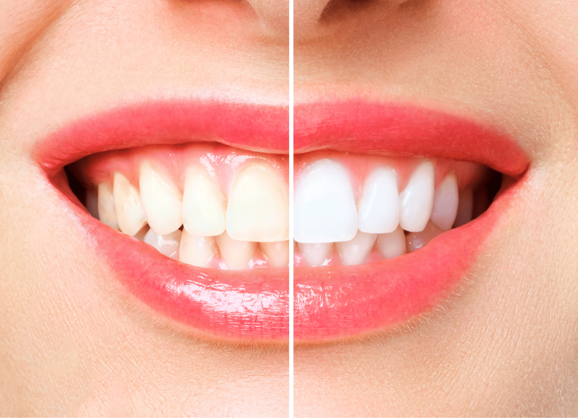 in-chair teeth whitening in-chair teeth whitening