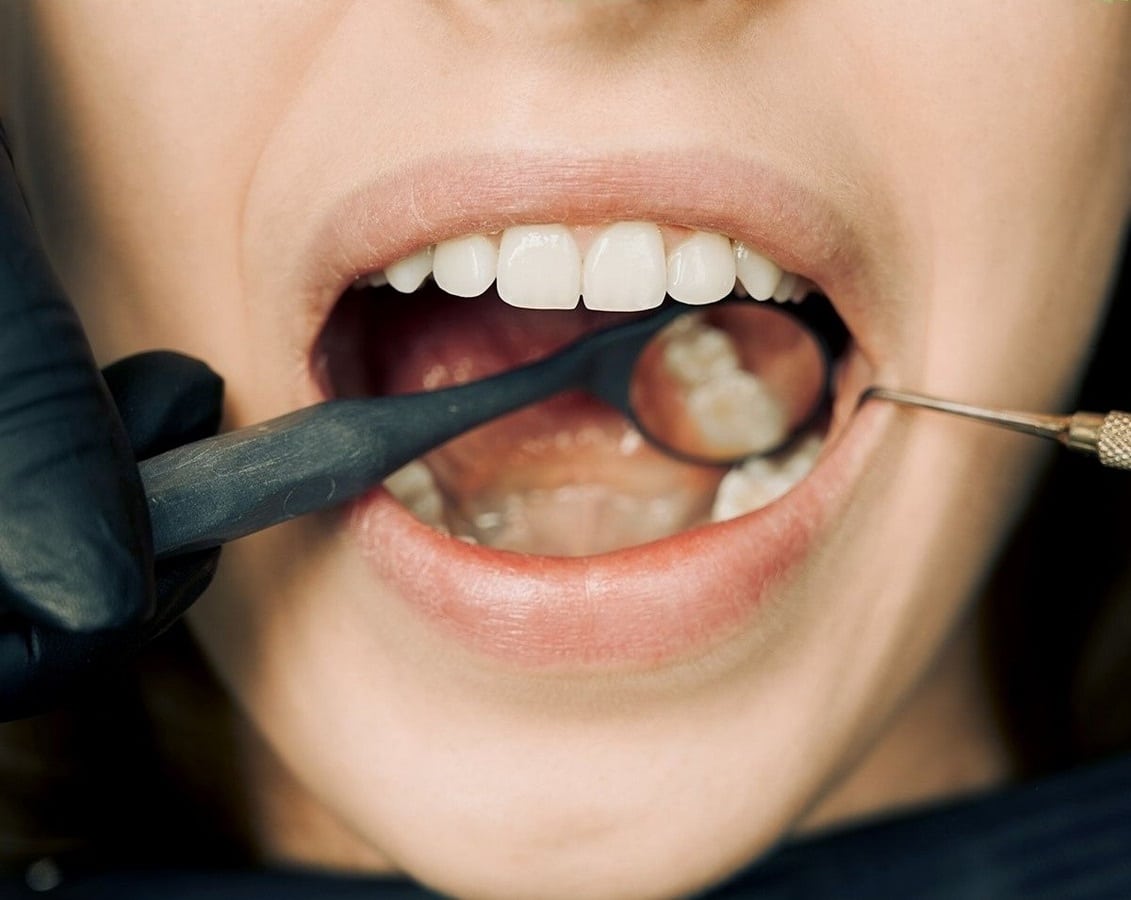 Front Tooth Cavity