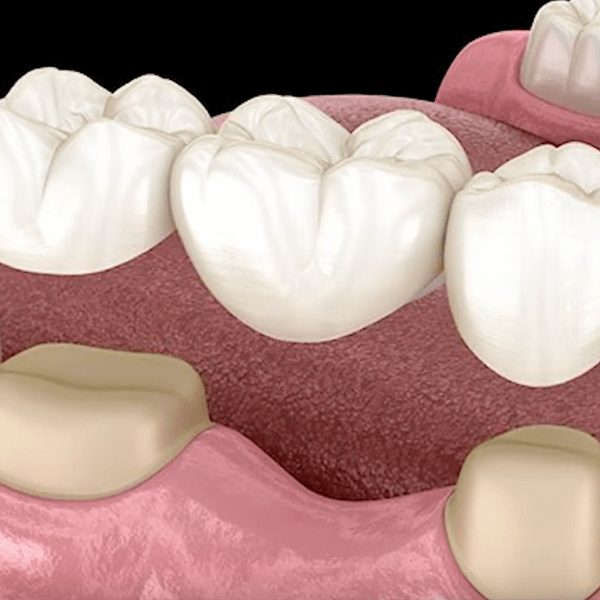 How Much Does a Dental Bridge Cost in Melbourne?