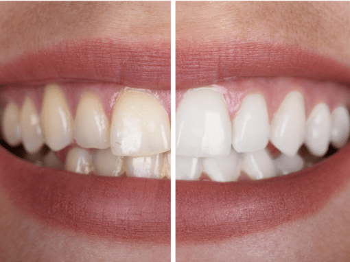 The Best Teeth Whitening Options for Sensitive Teeth