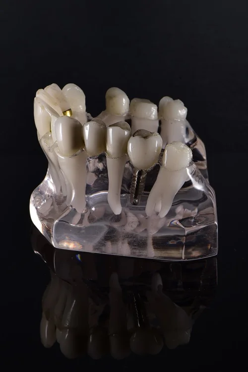 dental-implants-brighton Dental Implants at Lifestyle Smiles Brighton Dentist